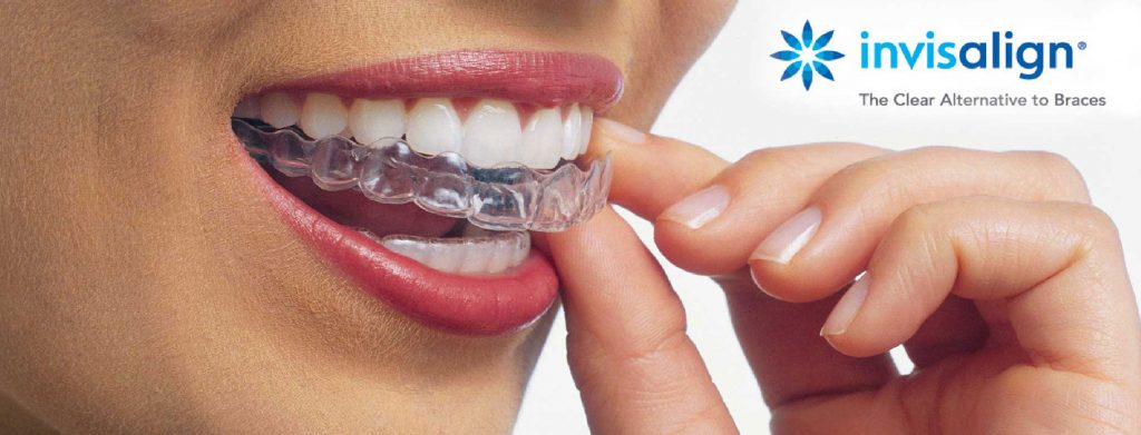 Clear Aligners or Invisible Braces: Everything You Need to Know About Clear  Braces 