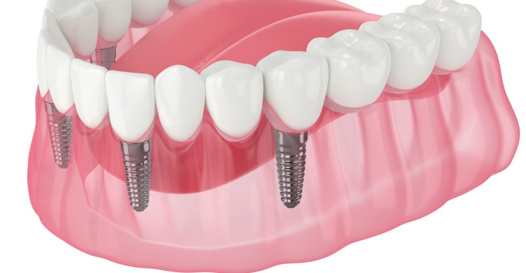 How Long Do Composite Fillings Last? Warrier Family Dentistry