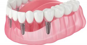 all-on-4 dental implants