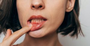gum recession