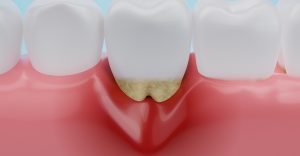 receding gums