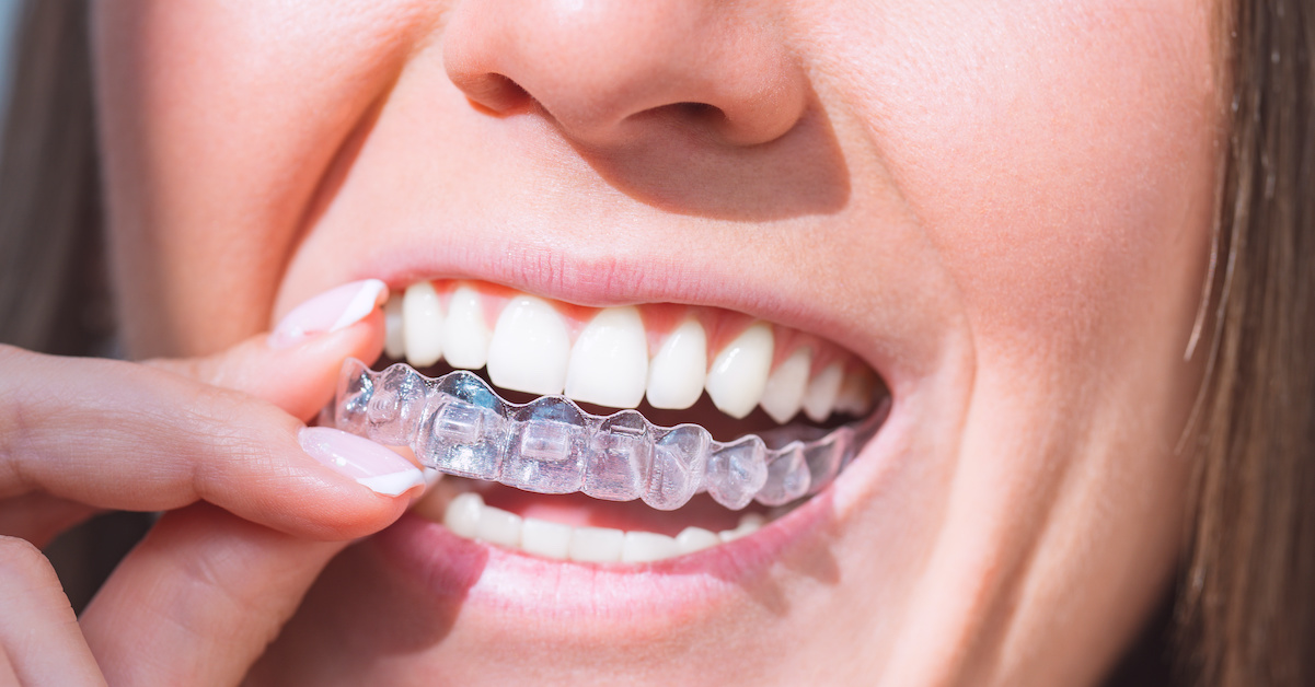 Are Clear Aligners Cheaper Than Braces? Warrier Family Dentistry
