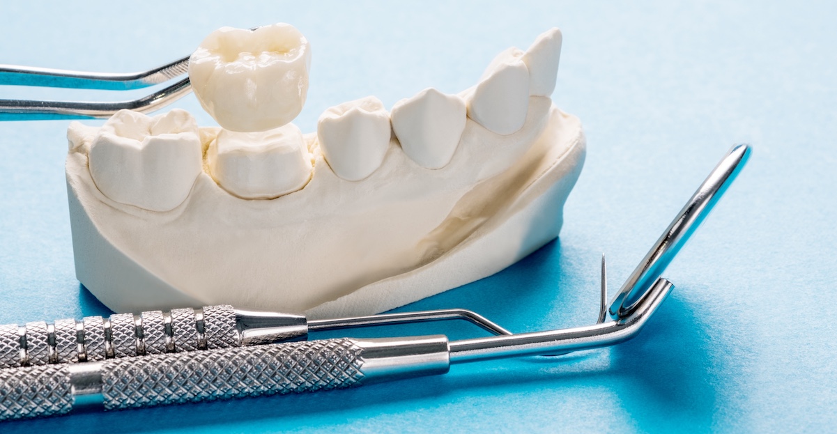 dental crowns that match your smile
