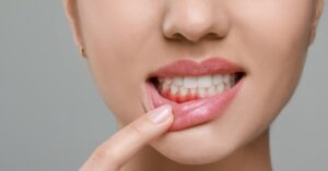 Early Signs of Gum Disease