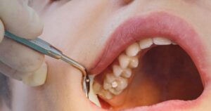 How Long Do Fillings Last?