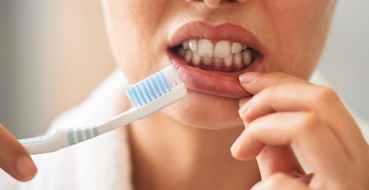 bleeding gums